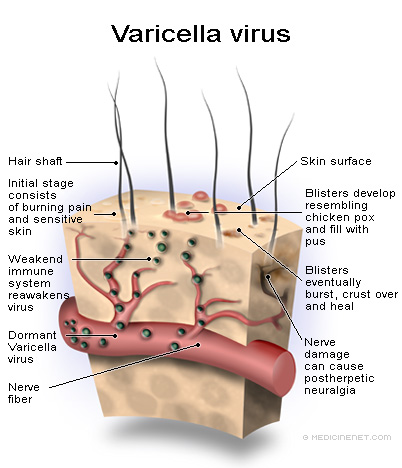 Virus varicella zoster adalah virus yang menyebabkan penyakit