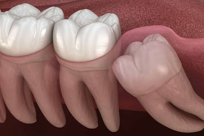 Kenali Impaksi Gigi dan Cara Mengatasinya