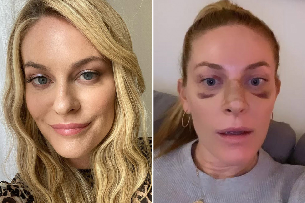 Leah McSweeney Reveals She Got A Nose Job; Says "I Am Not Trying To Hi...
