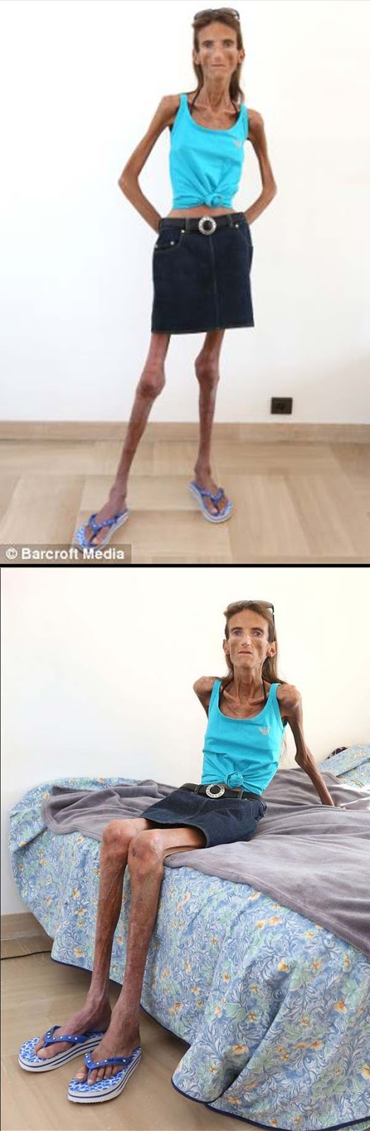 Health and Beauty in one site: Valeria Levitin: The Anorexia Sufferers Health and Beauty in one site: Valeria Levitin: The Anorexia Sufferers