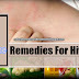Top 5 Home Remedies for Hives