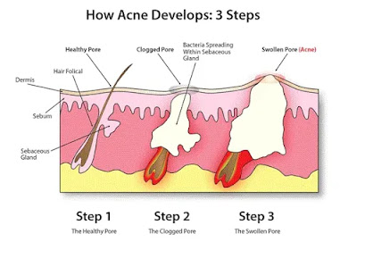 acne stage for formation