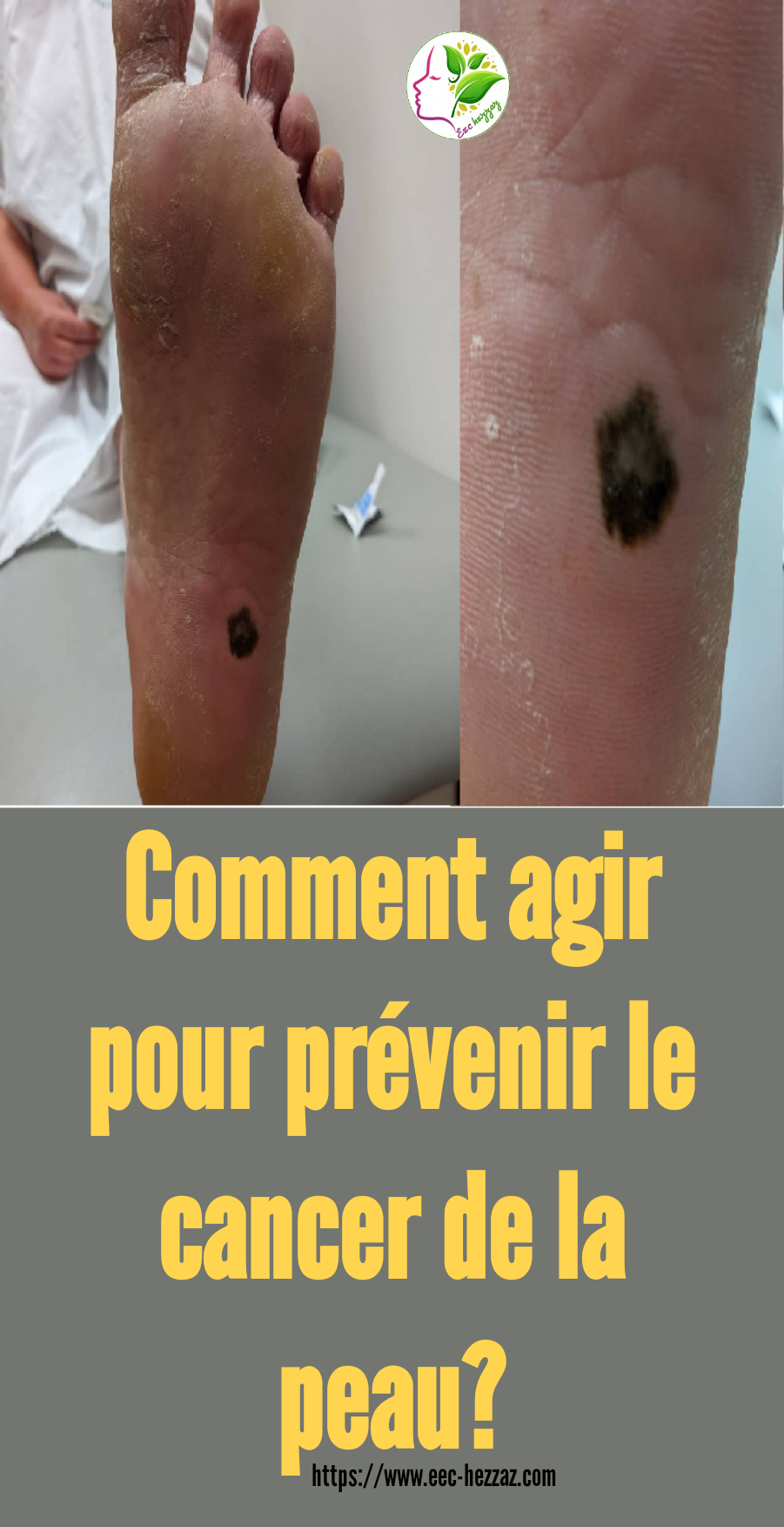 Comment agir pour prévenir le cancer de la peau?