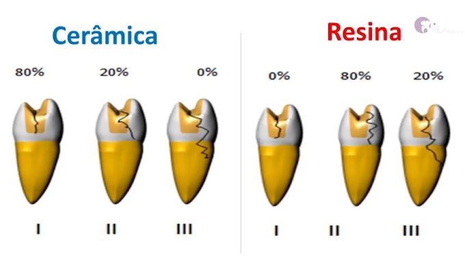 ENDODONTIA: Como Obter Previsibilidade em Restaurações com Retentores Intraradiculares