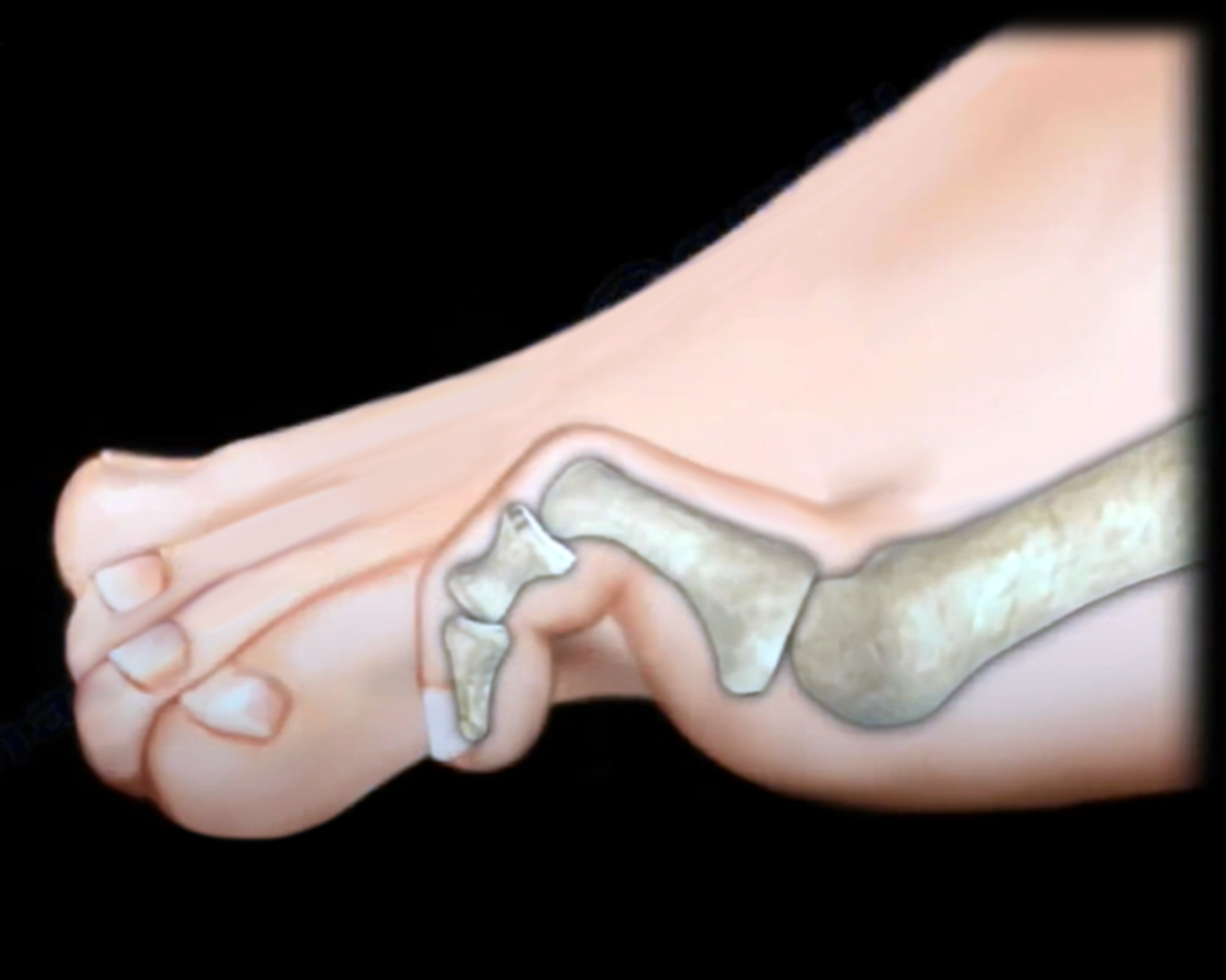 Dr. Nabil Ebraheim's Blogspot Claw Toe and More
