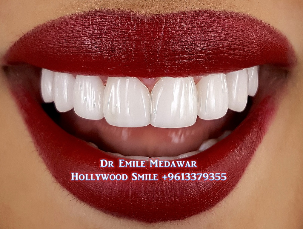Gummy Smile, Dr Emile Medawar, 00 961 3 379355 Veneers Lebanon Beirut, Great Smiles at Style