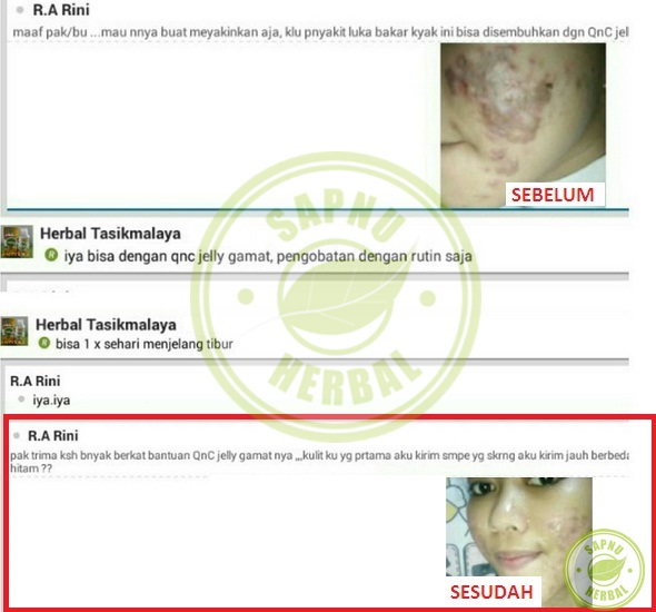 Ahlinya Obat Gatal ~ Testimoni Ahlinya Obat Gatal ~ Testimoni