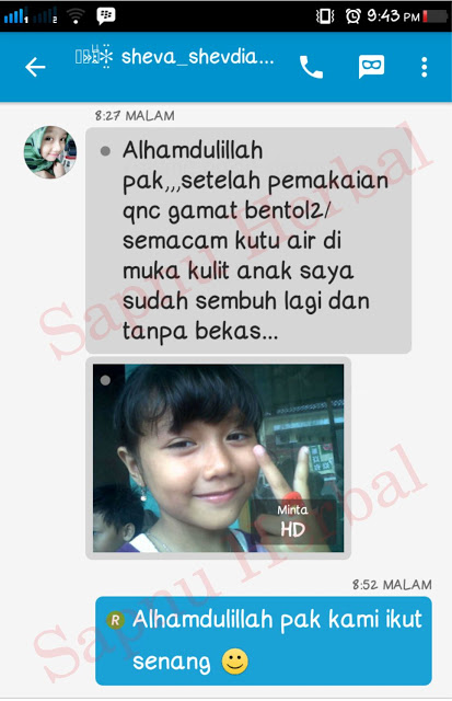 Cara Menghilangkan Bintik Merah Seperti Jerawat Di Kulit Perut Terbukti Mujarab ~ TESTIMONI QNC JELLY GAMAT Cara Menghilangkan Bintik Merah Seperti Jerawat Di Kulit Perut Terbukti Mujarab ~ TESTIMONI QNC JELLY GAMAT