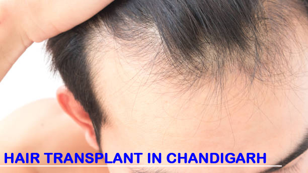 Hair Transplant in Chandigarh