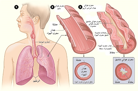 ما هو مرض الربو وكيفية الوقايه منه وعلاجه Asthma_attack-illustration_NIH-ar