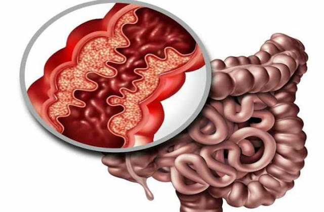 مرض كرون المعدة مرض كرون المعدة