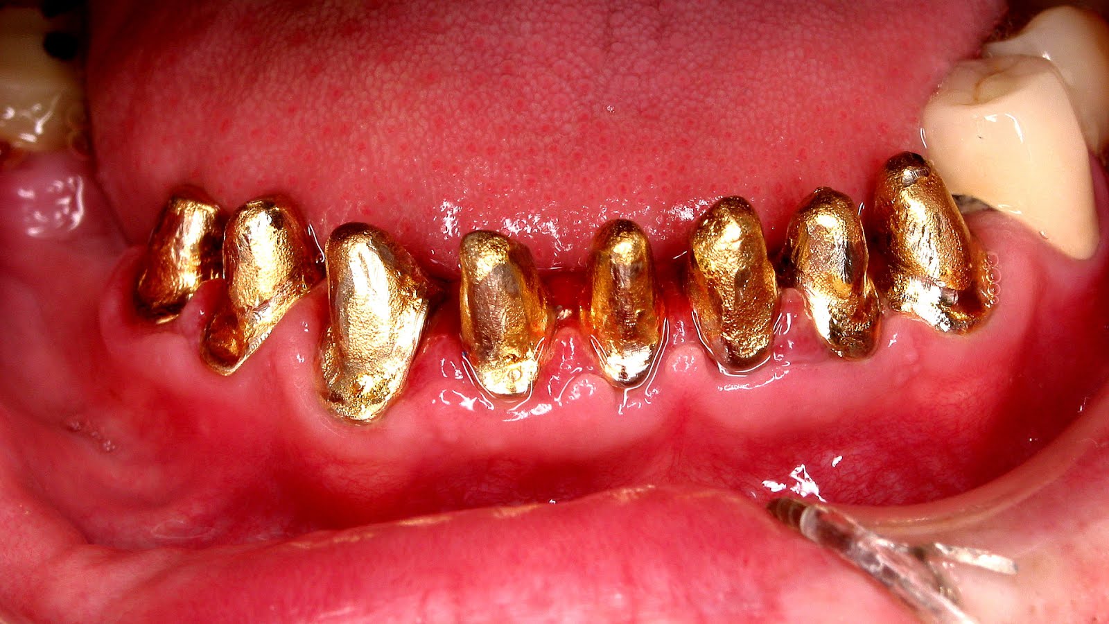 Dental braces Gold Braces Gold Choices