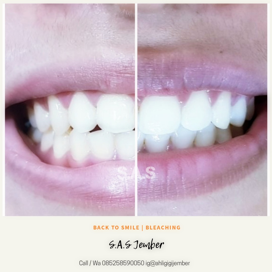 Harga Bleaching Gigi Di Jember Terbaru