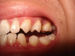 Chỉnh răng thưa ở đâu để mang lại hiệu quả cao cần tìm hiểu kỹ lưỡng trước khi lựa chọn Chỉnh răng thưa ở đâu để mang lại hiệu quả cao cần tìm hiểu kỹ lưỡng trước khi lựa chọn