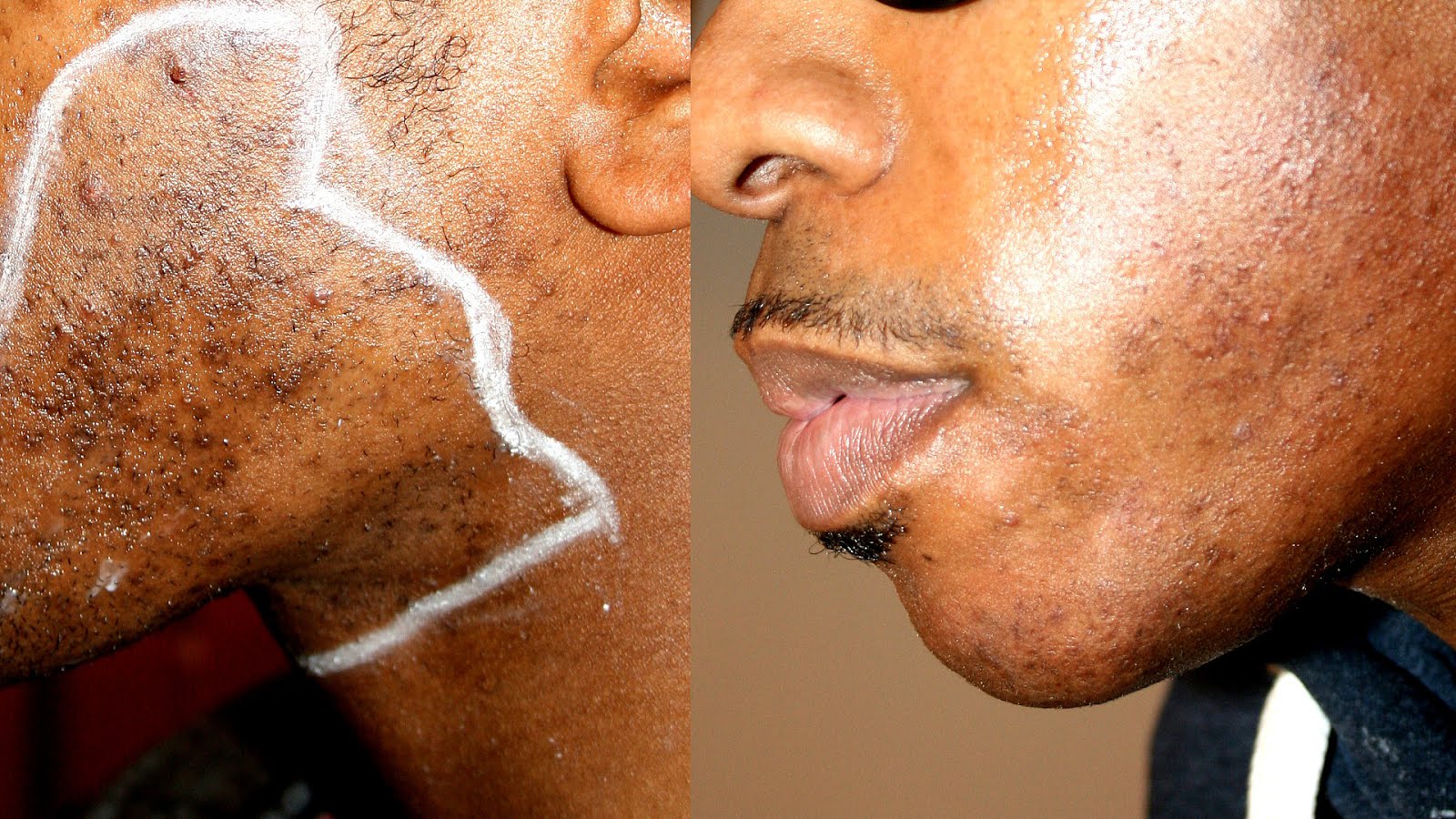 Laser hair removal african american near me Clearance