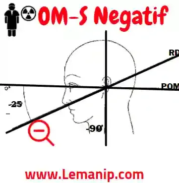 Lorsque l'angle formé par le RD (rayon directeur) est ouvert vers le bas et en haut : alors il est dit negatif. (-)