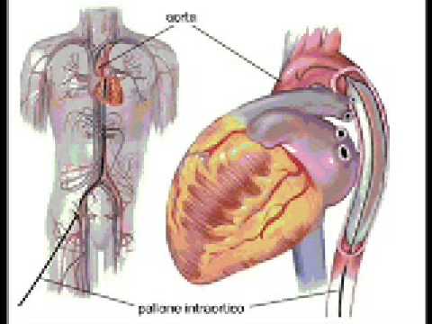 balon contrapulsacion