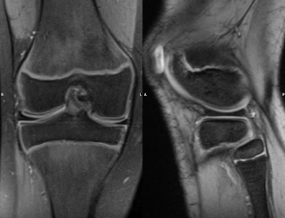 Incomplete discoid lateral meniscus
