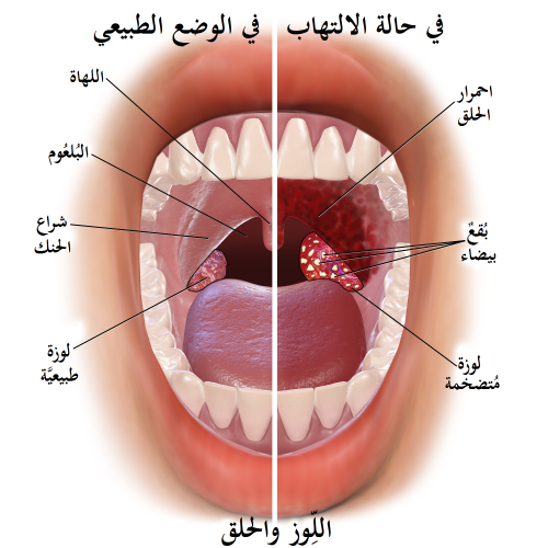 التهاب الحلق معارف المدونة العربية