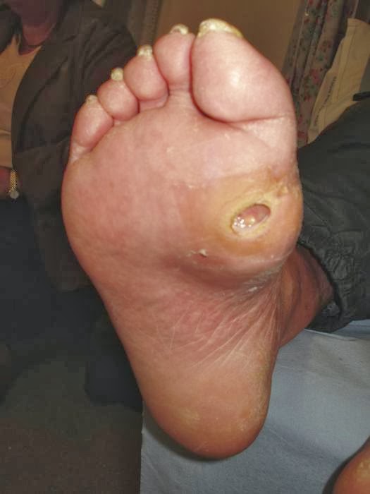 foot ulcer pictures