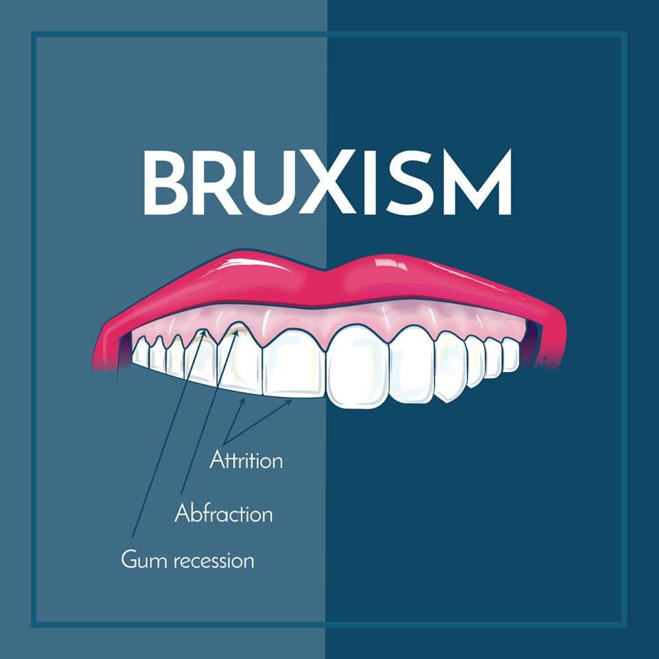 Seattle Dentist BRUXISM