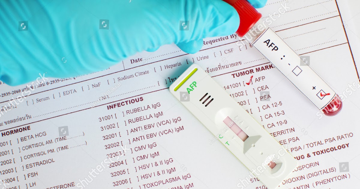 តេស្ត Alpha-fetoprotein (AFP) Tumor Marker - SINAN-KH