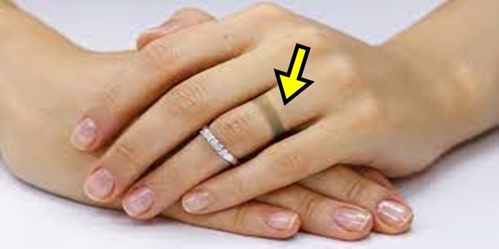 ఉంగరం గుర్తులను తొలగించటానికి బెస్ట్ టిప్స్ 