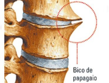 Bico de Papagaio lu tudo sobre tudo e o que é o bico de papagaio