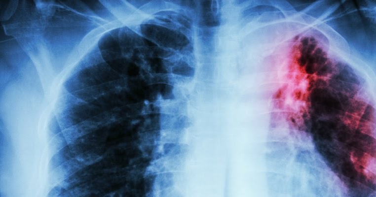 Ciri-ciri penyakit paru paru ,penyebab ,gejala ,pengobatannya