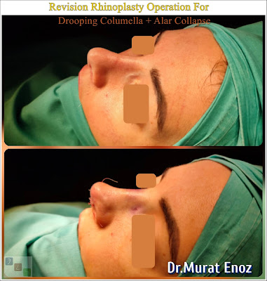 Secondary Revision Nose Aesthetics For Alar Collapse, Drooping Columella and Overprojected Nose Tip Treatment
