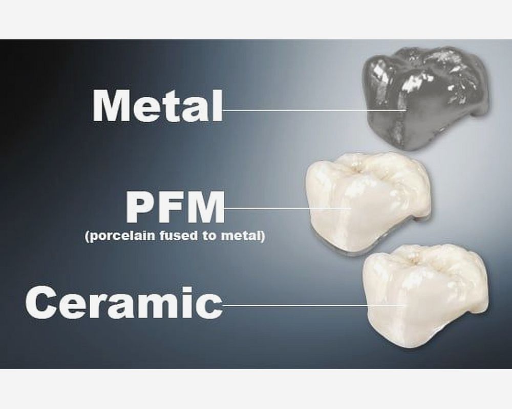 Dental Crown Types. Which is Best? OdontoVida