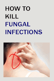 HOW TO KILL FUNGAL INFECTIONS
