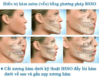 Phẫu thuật hàm móm bằng phương pháp BSSO Phẫu thuật hàm móm bằng phương pháp BSSO