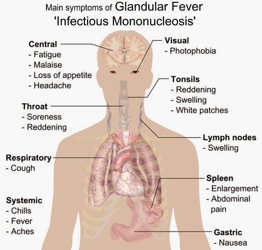 Symptoms Of Glandular Fever, Infectious Mononucleosis