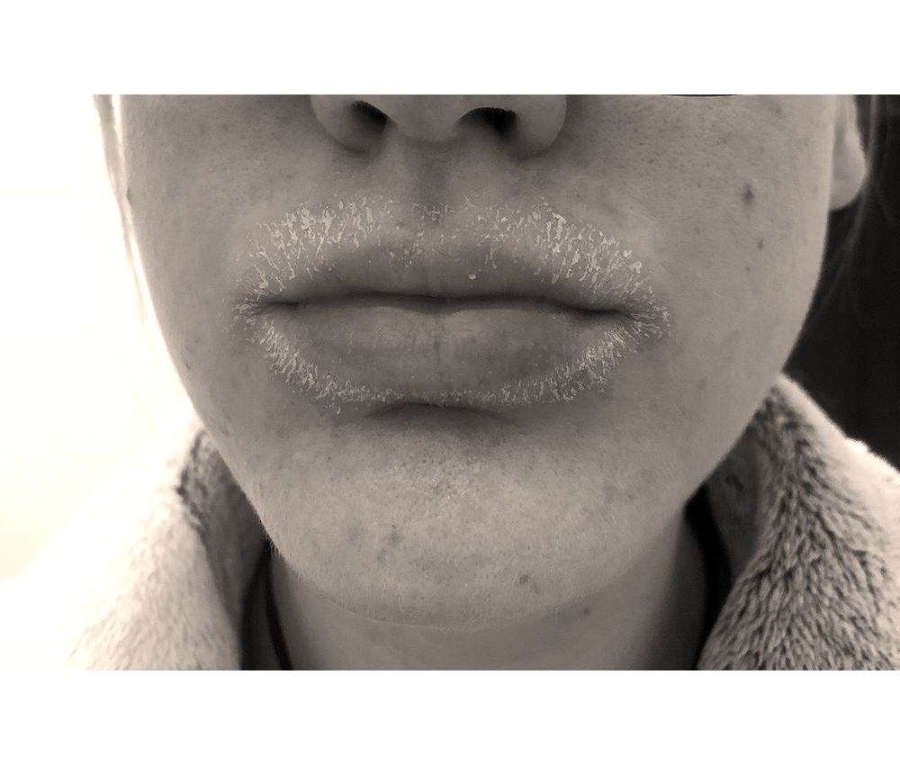 Red rash around your mouth could be perioral dermatitis Directorio Odontológico