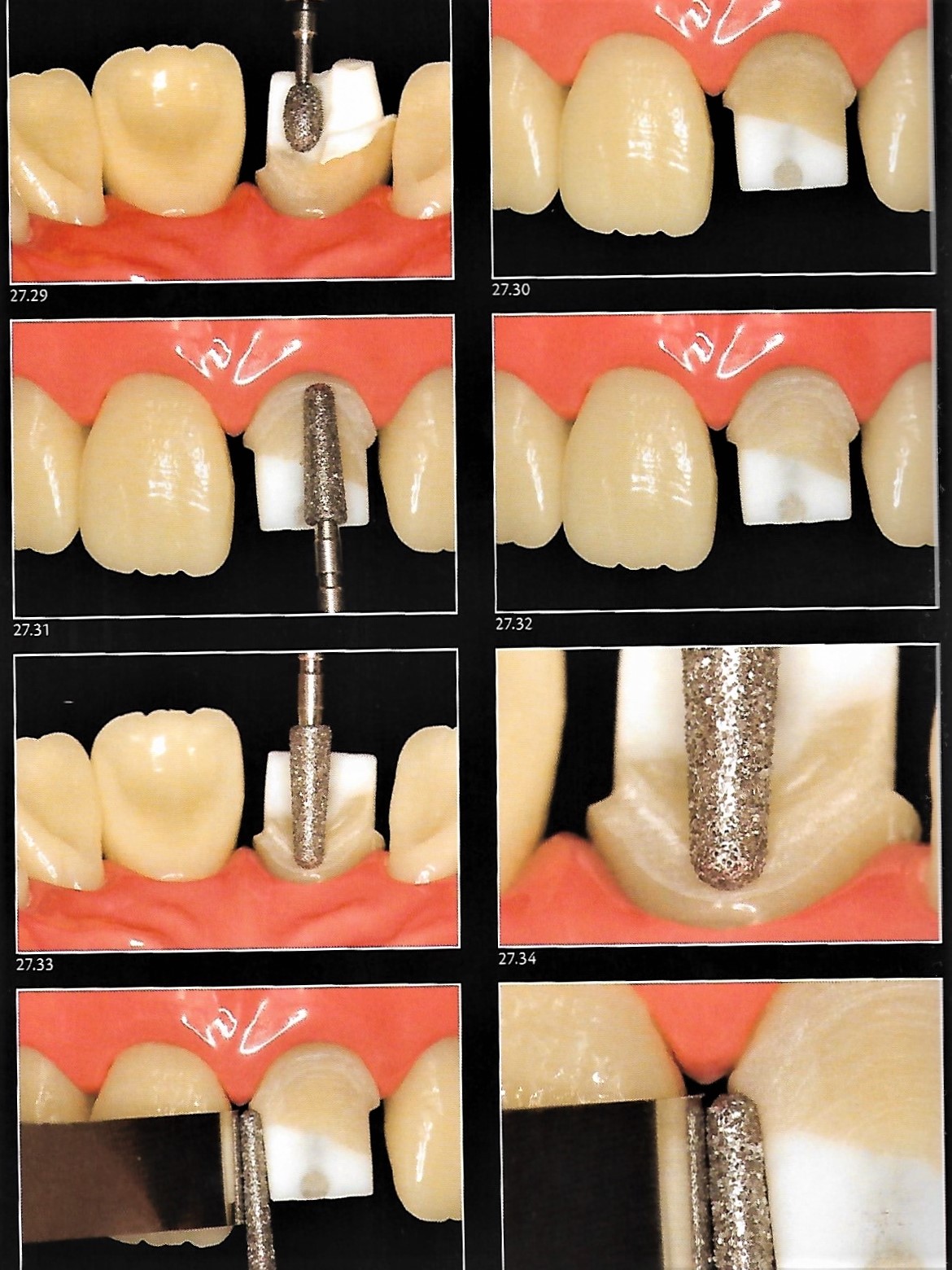 Anterior Crown Preparation Dental Esthetics