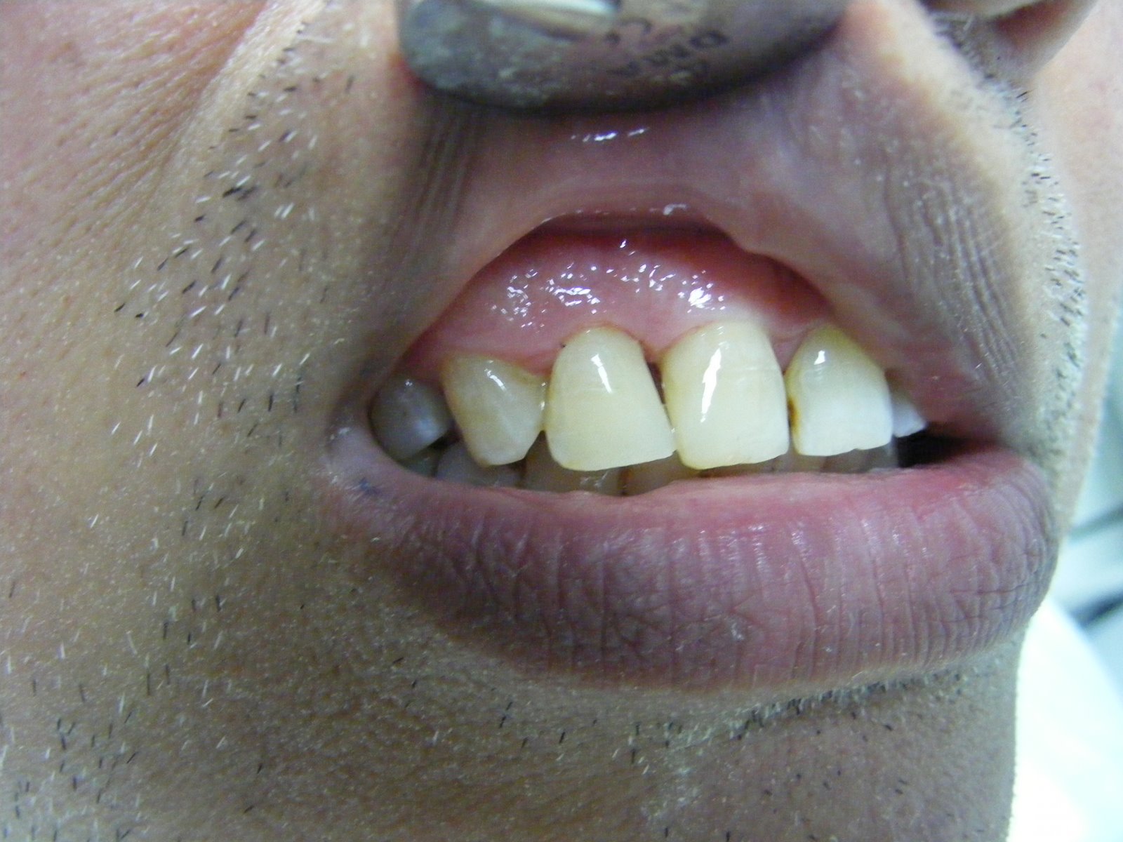 Ayrık diş kapatılması