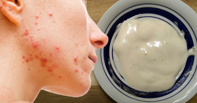 Mascarilla de miel, bicarbonato de sodio y vinagre de manzana para limpiar el acné de tu piel