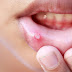 Exfoliative Cheilitis - Pictures, Causes, the best Treatment and Diet