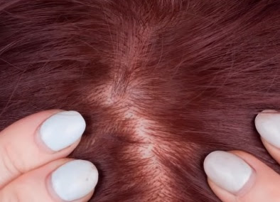 Can White Hair Turn Black Again Naturally