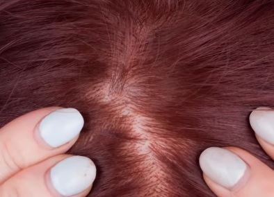 Can White Hair Turn Black Again Naturally