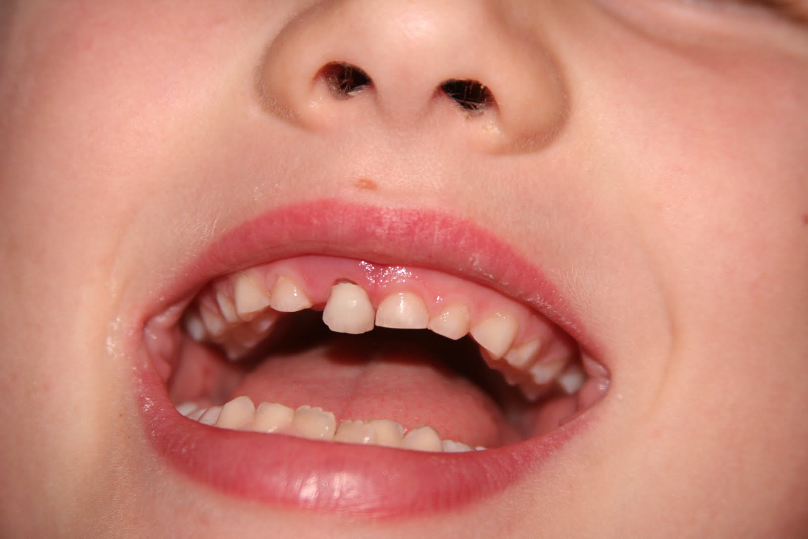 My tooth fell out!