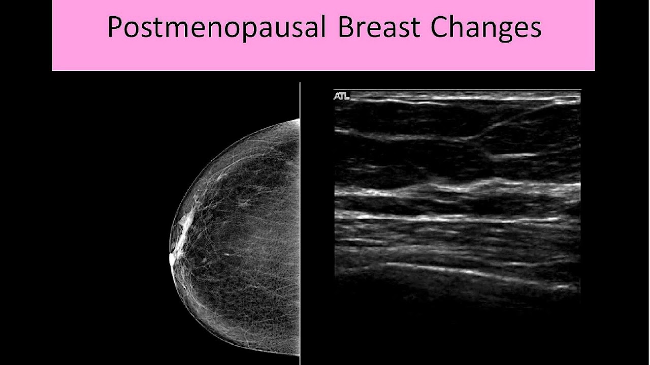 Breast Cysts Menopause Menopause Choices