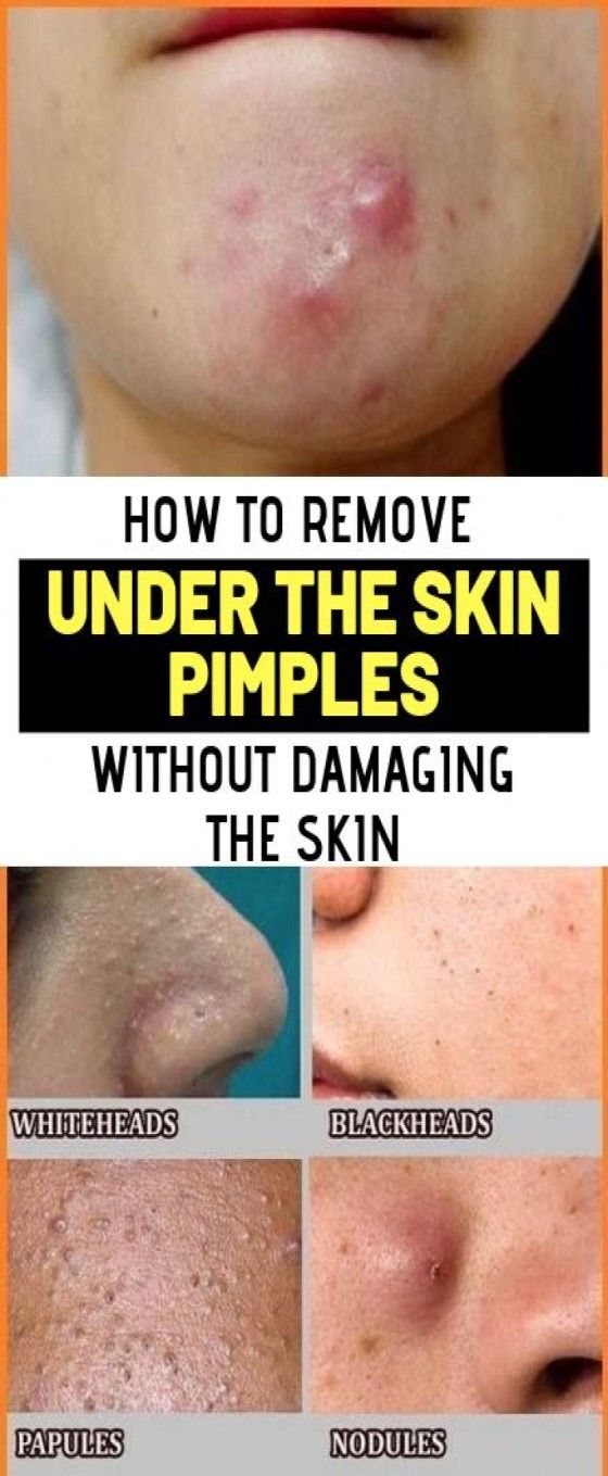 remove-under-the-skin-pimples-without-damaging-your-skin-health-and