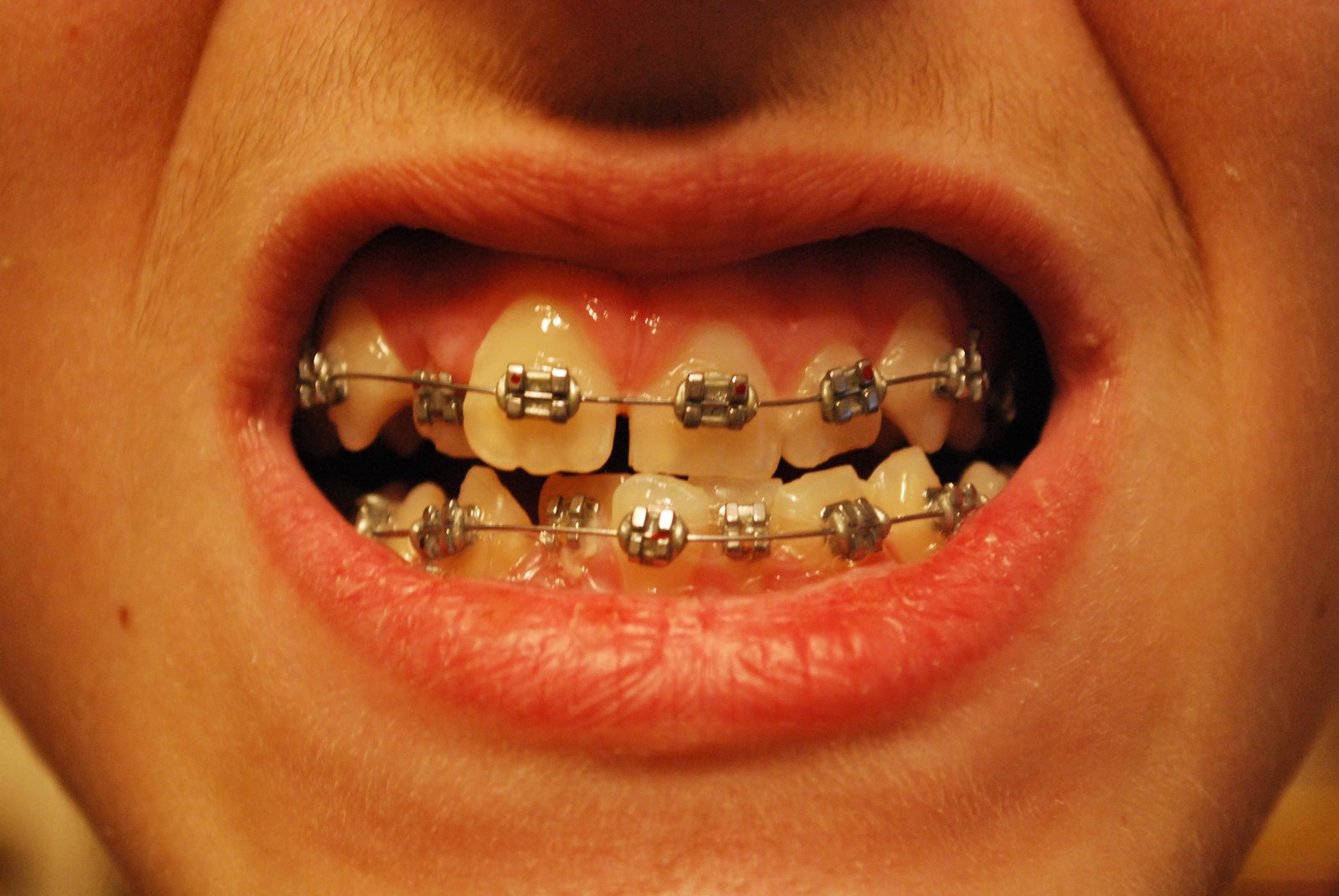 Life at the Gables The braces are off