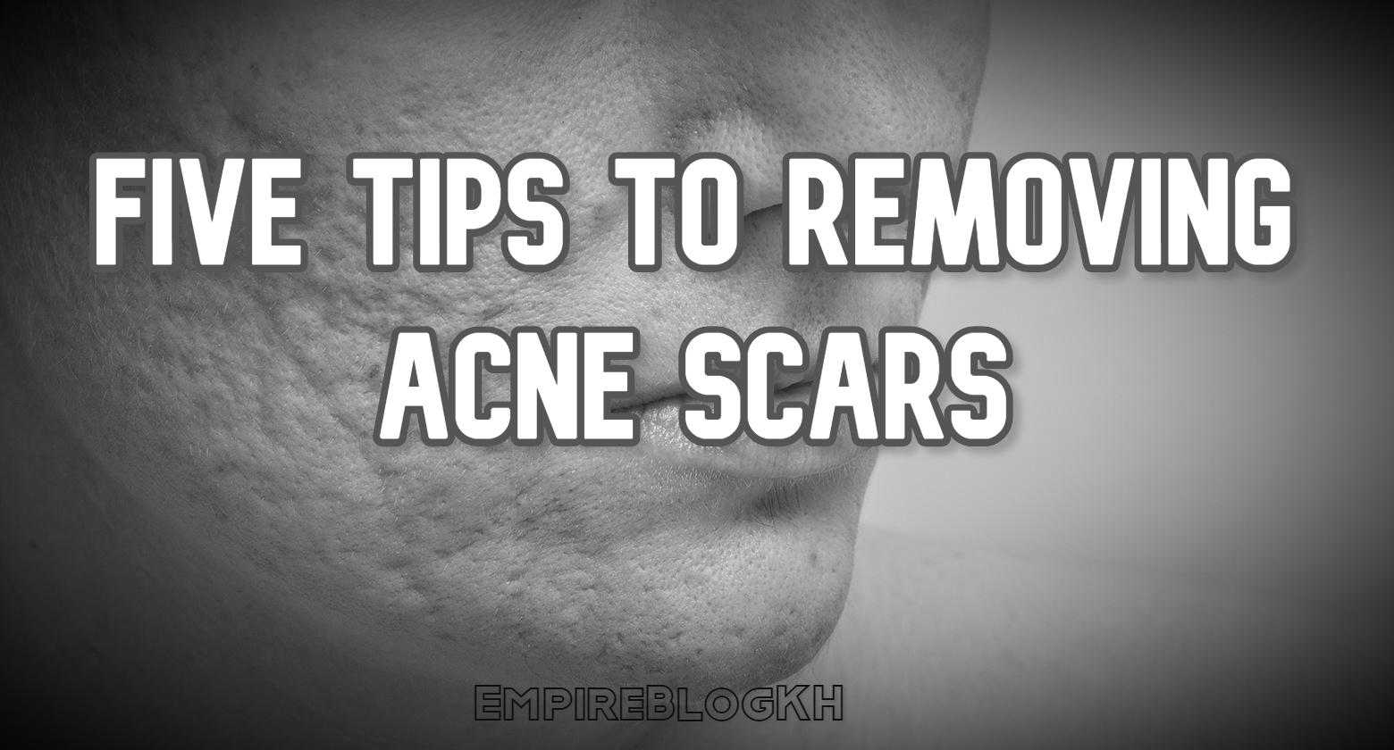 Five Tips To Removing Acne Scars Empire Blog KH