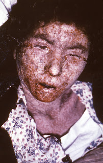 Cildi geç evre konfluent makülopapüler skarlaşma özellikleri sergileyen İtalyan bir kadın çiçek hastalığı hastası, 1965.