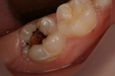  Cách khắc phục sâu răng hàm trên