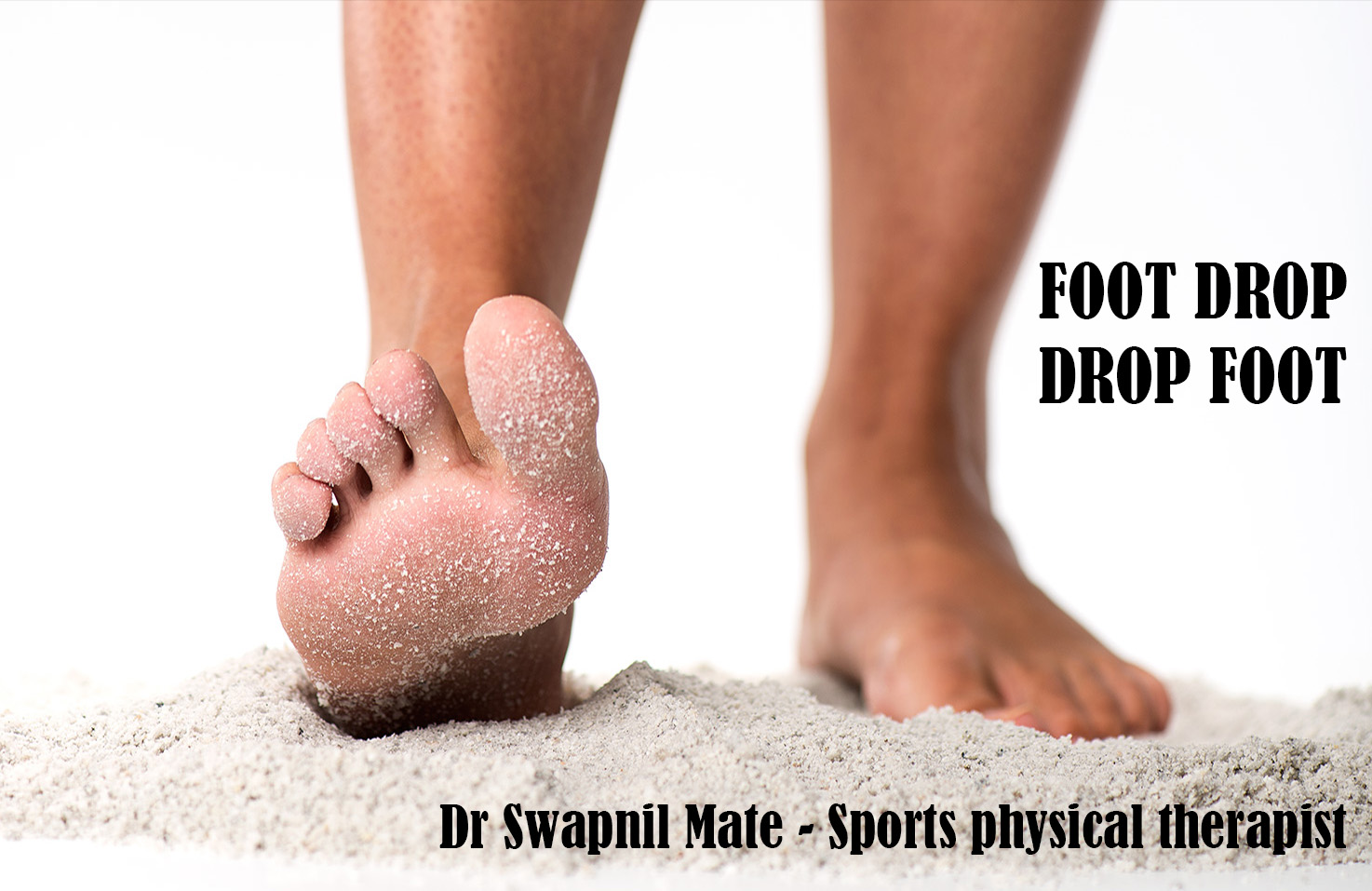 Dry Needling HPE INDIA Healthcare, Physiotherapy and Ergonomics