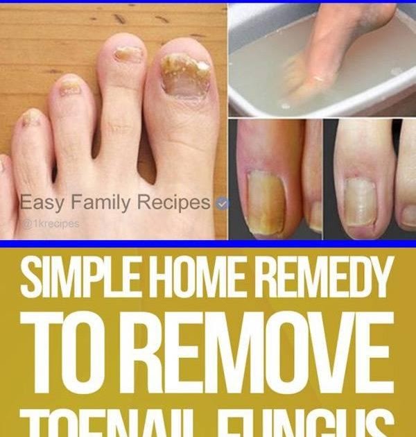Get Rid of Toenail Fungus with Just 2 Ingredients 😍